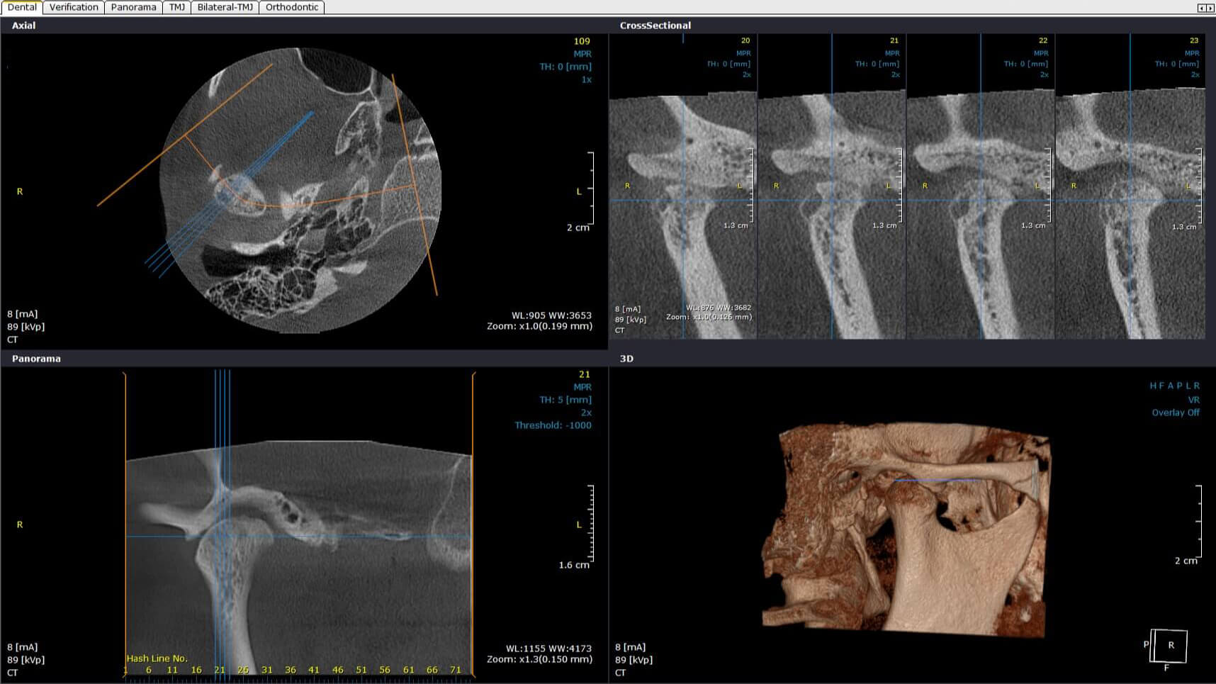 Investigatii imagistice 3D: CBCT – tomografie computerizata cu fascicul conic